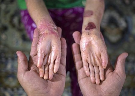 پیگیری دستور آیت الله رییسی در مورد بیماران EB