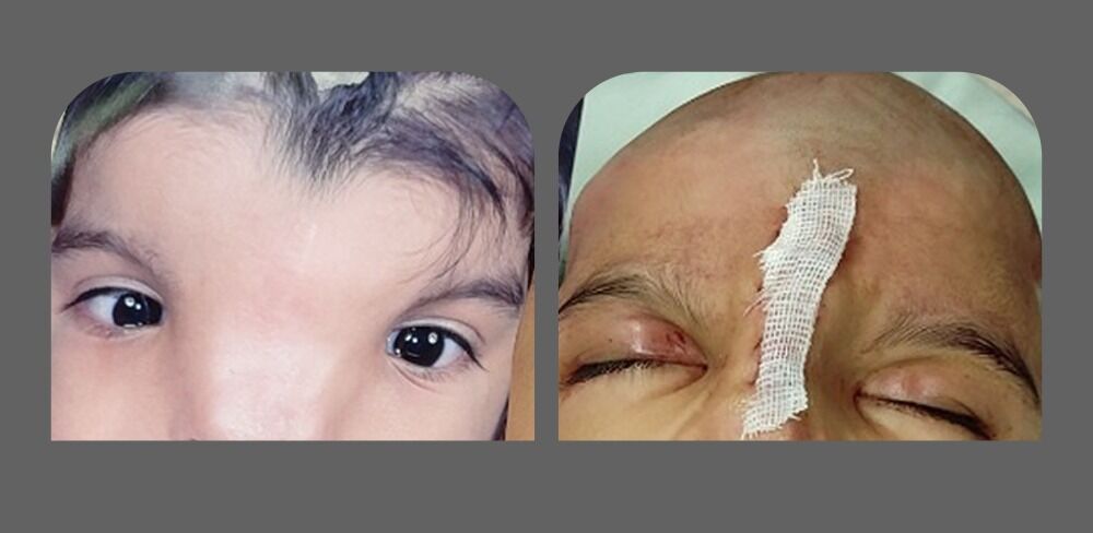 ناهنجاری چهره و جمجمه دختر ۴ ساله در شیراز درمان شد