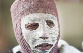 درد بی درمان سوختگی در ایران